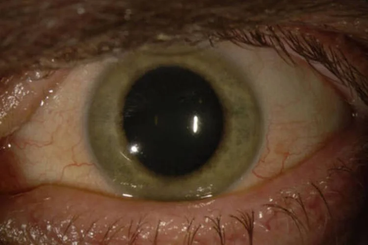 
	Olho com Ebola: o v&iacute;rus alterou a cor da &iacute;ris de um m&eacute;dico sobrevivente da epidemia
 (Emory Eye Center)