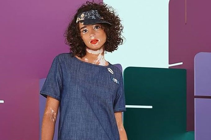 Modelo da C&A com vitiligo ganha “aplausos” na web
