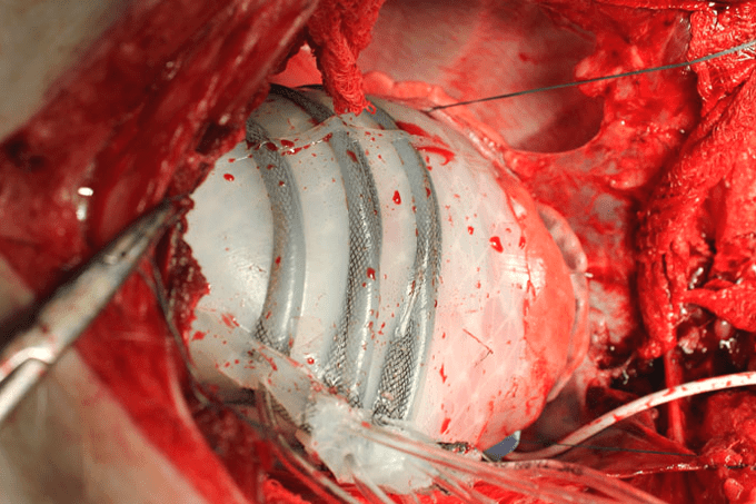"Luva" robótica espreme coração para que o órgão continue a bater