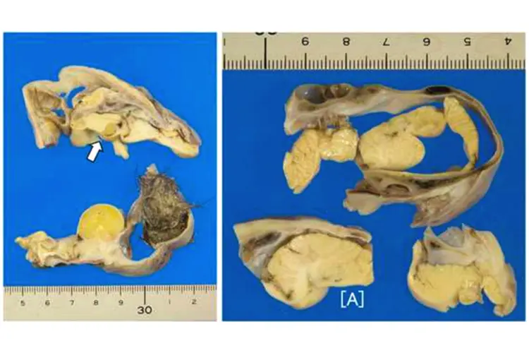 Teratoma: ele continha pedaços de pelo, crânio e matéria cerebral desenvolvido (Masayuki Shintaku/Divulgação)