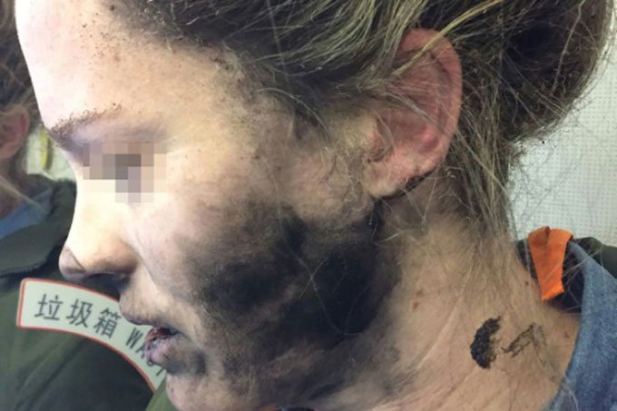 Mulher sofre queimaduras após explosão de fones de ouvido em voo