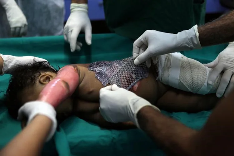 Tratamento com a tilápia pode acelerar a cura em vários dias e reduz a necessidade de analgésicos (Paulo Whitaker/Reuters)