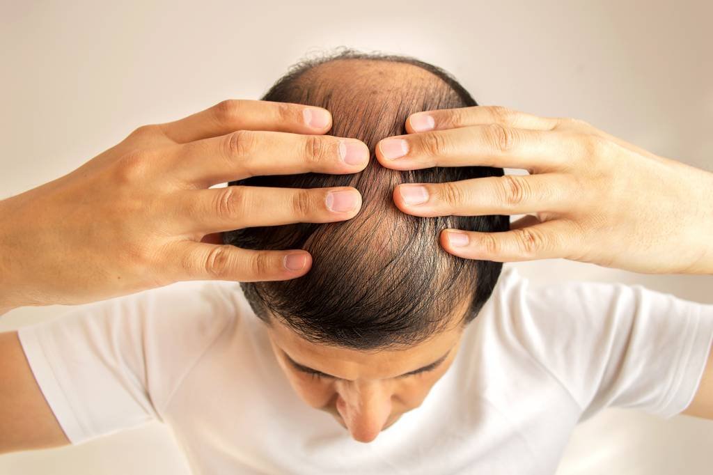 Calvície: estimativa é de que 70% dos homens já sofrem ou sofrerão com a queda de cabelos (Reprodução/Thinkstock)