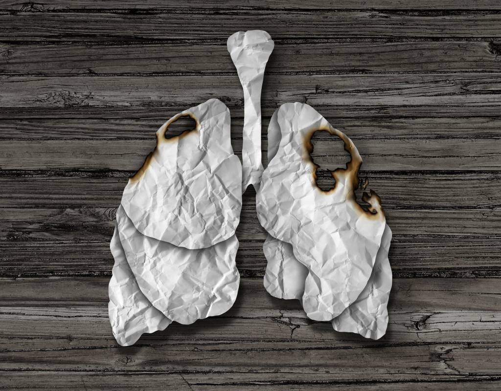 Avanços na tecnologia de diagnóstico contribuem para redução da letalidade do câncer de pulmão