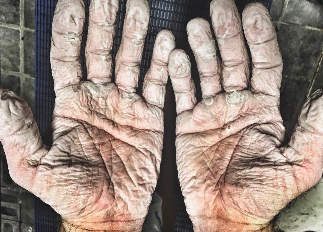 Foto das mãos de remador olímpico mostra lado brutal do esporte