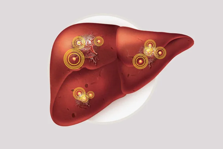 Hepatite A: de acordo com o último boletim epidemiológico, publicado no dia 13 de setembro pelo governo, foram 180 acometidos até agora (Ilustração: Erika Onodera/Saúde)