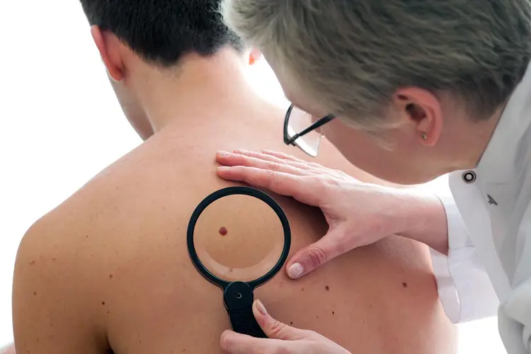 Melanoma: grupo da USP identifica genes relacionados à progressão da doença (AlexRaths/Thinkstock)