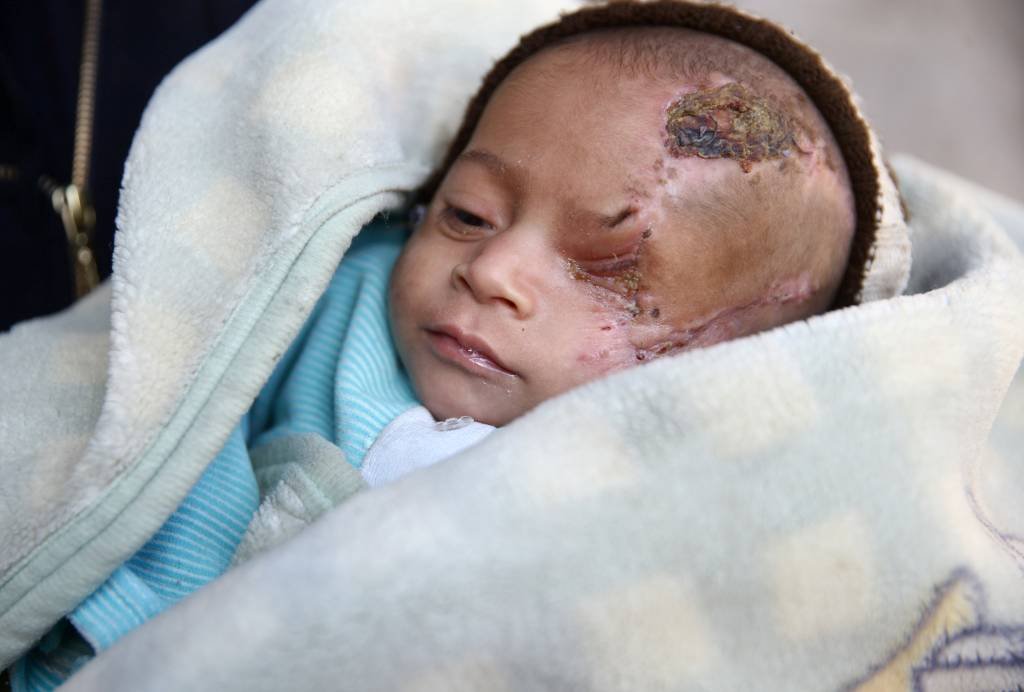 Bebê sírio que perdeu olho em ataque do regime vira símbolo