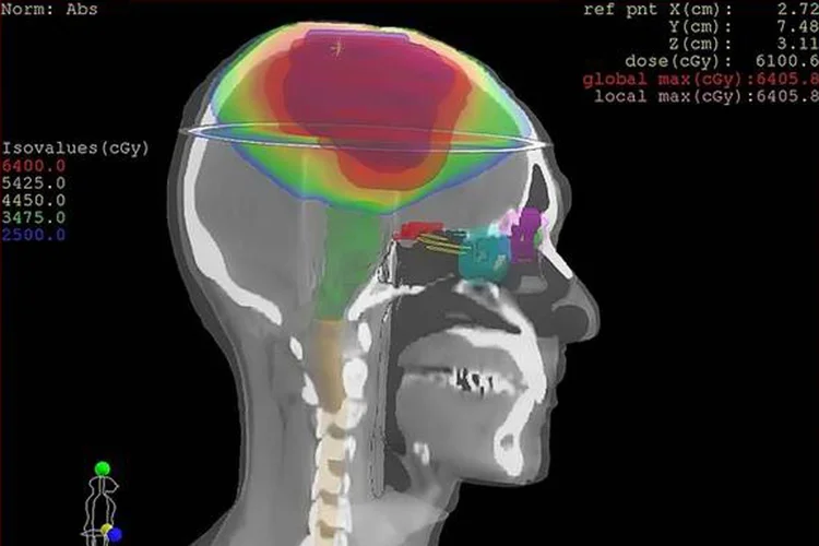 Tumor: com peso de 1,87 kg, foi considerado "o maior do mundo" (Ansa/Ansa)