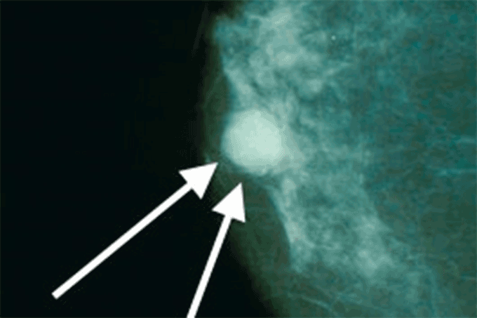 Novo estudo analisa reincidência do câncer de mama