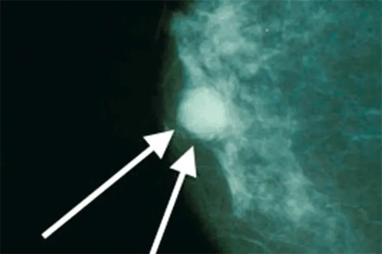 Câncer de mama: Dispositivo desenvolvido por pesquisador da UFSCar recebe menção honrosa no Prêmio Mercosul de Ciência e Tecnologia  (Bakerstmd/Wikimedia Commons)