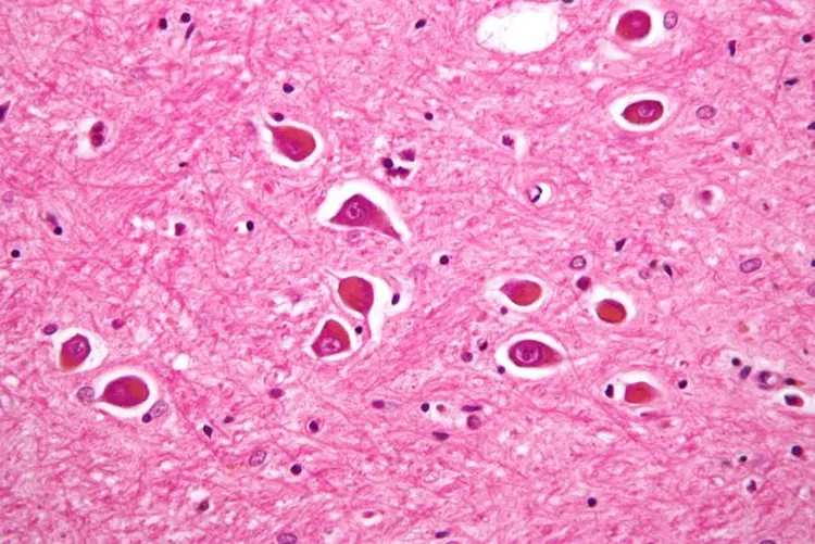 Alzheimer: FDA tem poucas drogas aprovadas para o tratamento da doença, e os fármacos disponíveis fornecem só alívio limitado dos sintomas (Micrográfico de alzheimer tipo II/Wikimedia Commons)