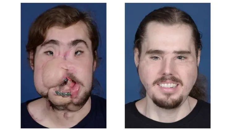 Transplante: fotos de Cameron Underwood em março de 2017 (antes da operação) e em 26 de novembro de 2018 (NYU Langone Health/Reprodução)