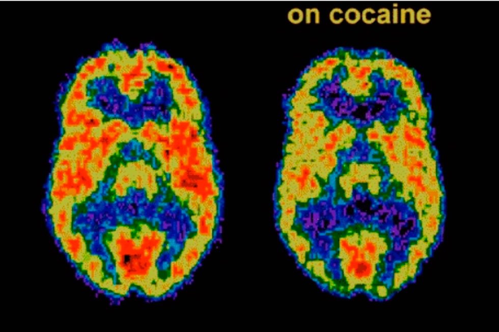 Estudo pode ajudar a prever recaída em dependentes de cocaína