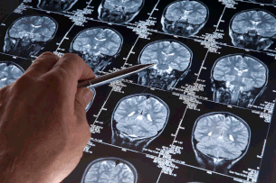 Medicamento usado para tratamento de esquizofrenia pode revolucionar tratamento do Alzheimer