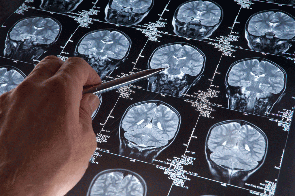 Estudo que mapeou a bioquímica e anatomia do cérebro de 174 pacientes do transtorno neurológico (Getty Images/haydenbird)