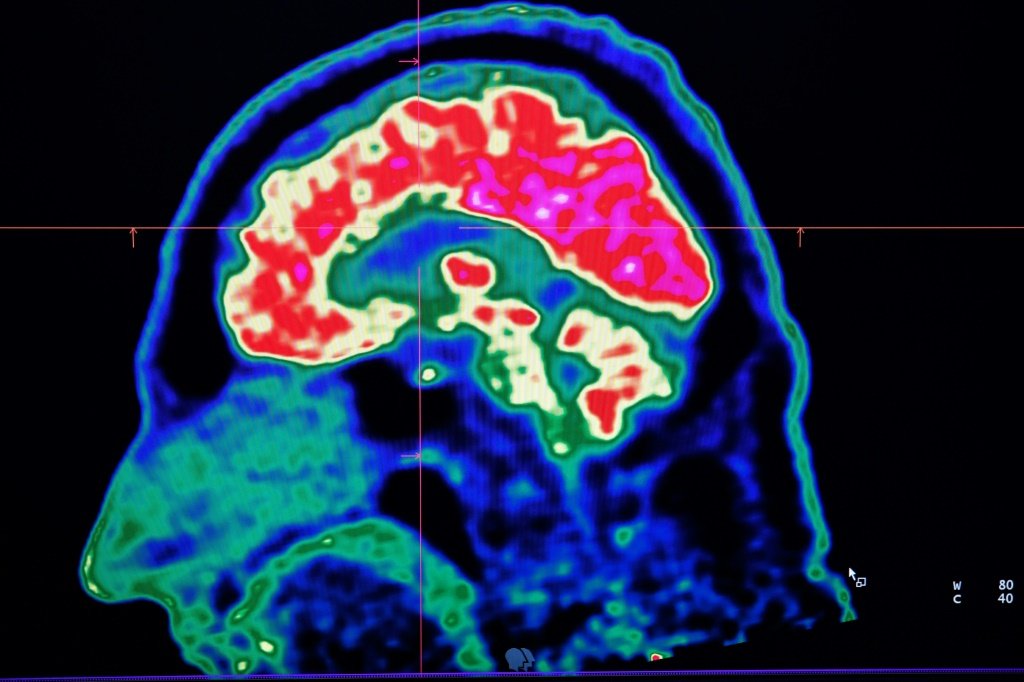 Estudo analisa como o cérebro aumenta ou diminui a percepção da dor