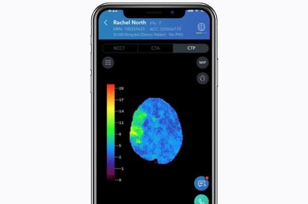 Startup de tecnologia que detecta sinais de AVC recebe US$ 50 milhões