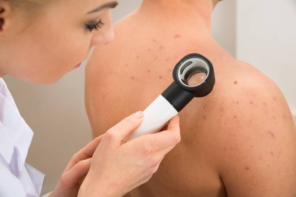 Câncer de pele: o melanoma representa 3% dos casos de câncer de pele no Brasil (Getty Images/Reprodução)