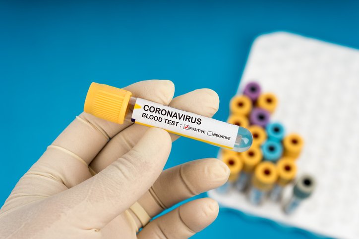 Startup vai lançar exame de coronavírus em farmácia por R$ 130 — ou menos