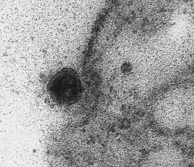 Coronavírus: Imagem de microscopia mostra à esquerda o Sars-Cov-2, o novo coronavírus, atacando a membrana de uma célula (IOC/Fiocruz/Divulgação)