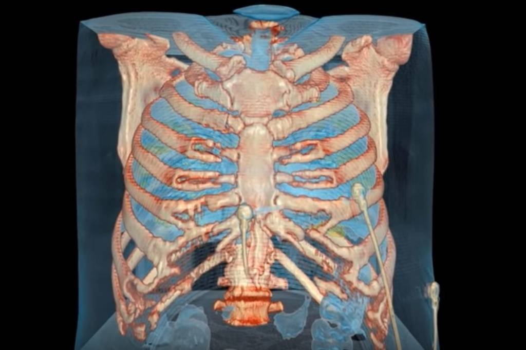 Coronavírus: novo vídeo procura estudar como os pulmões são afetados pelo vírus (YouTube/Reprodução)