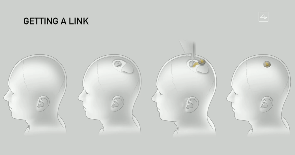 Neuralink: dispostivo da empresa transmiste dados e impulsos cerebrais por conexão sem fio (Neuralink/YouTube/Reprodução)