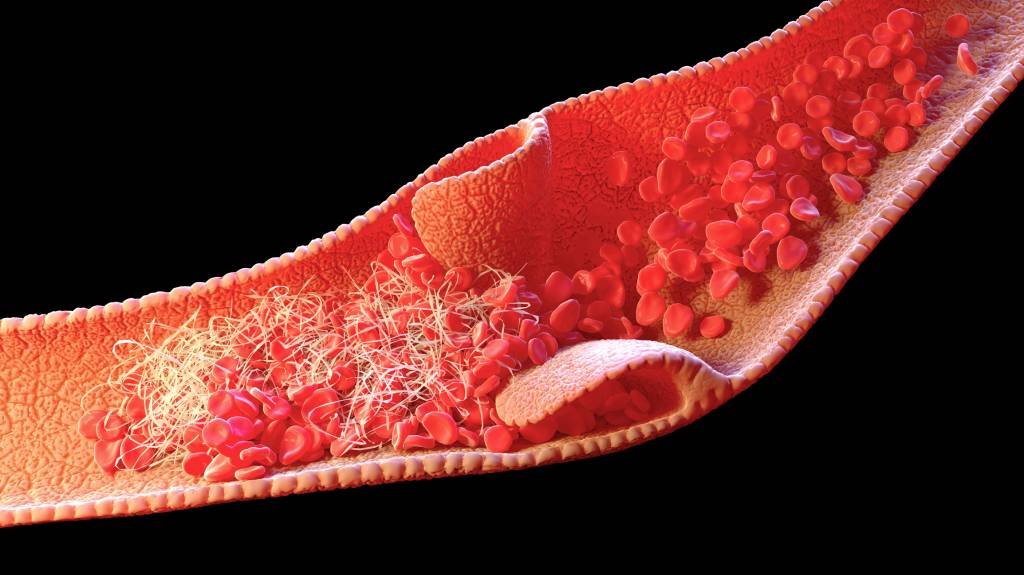 Trombose: anticorpos liberam uma rede de material genético que prende partículas do vírus fora das células (NANOCLUSTERING/SCIENCE PHOTO LIBRARY/Getty Images)