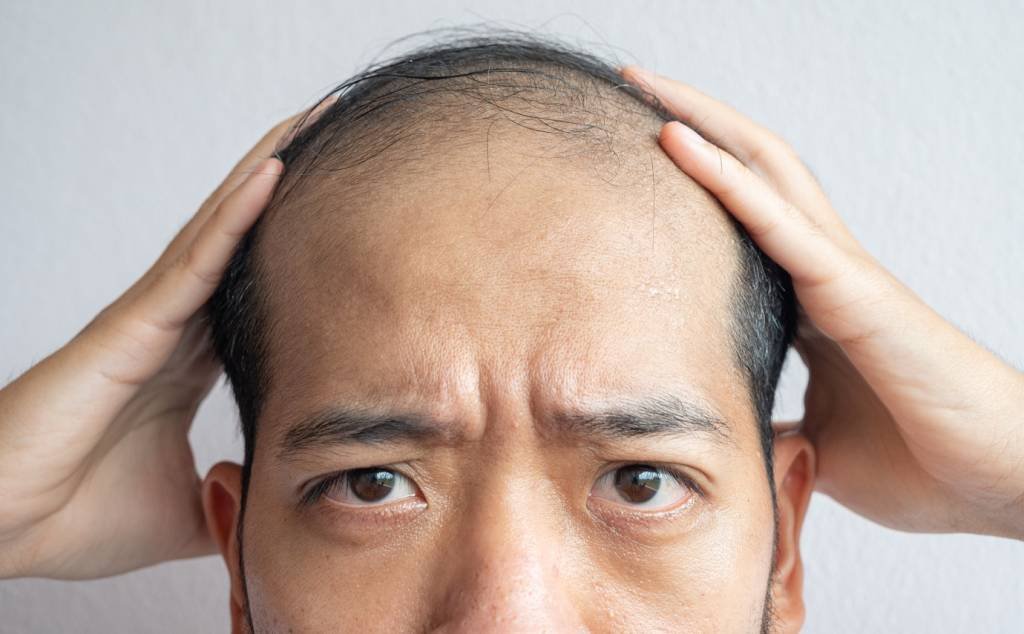 Calvice: conheça a técnica dos baldlocs (Boy_Anupong/Getty Images)