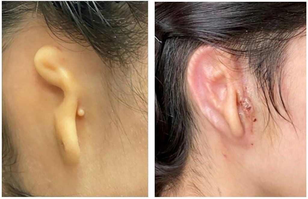 Paciente recebe implante de orelha impressa à base de células humanas