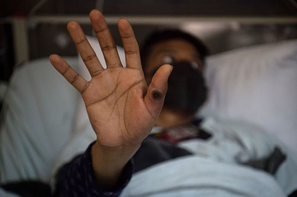 Monkeypox: paciente com as lesões características da doença. (ERNESTO BENAVIDES/AFP via/AFP)