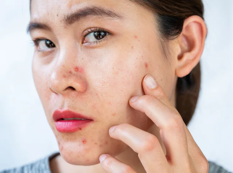 Acne: estudo explica por que espremer espinhas é tão satisfatório (Getty Images/Reprodução)