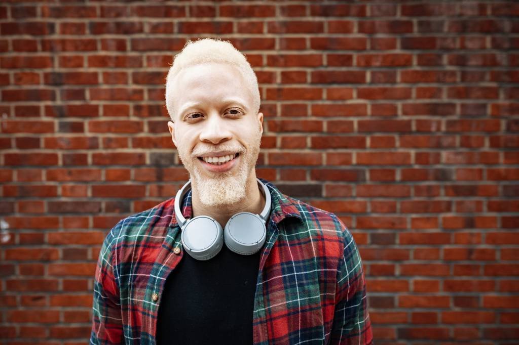 O que é albinismo? Saiba cuidados necessários com a saúde em pessoas com essa condição