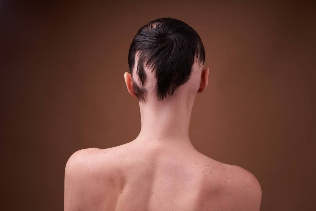 Perda de cabelo afeta 2% da população mundial e tem impacto emocional (Darya Komarova/Getty Images)