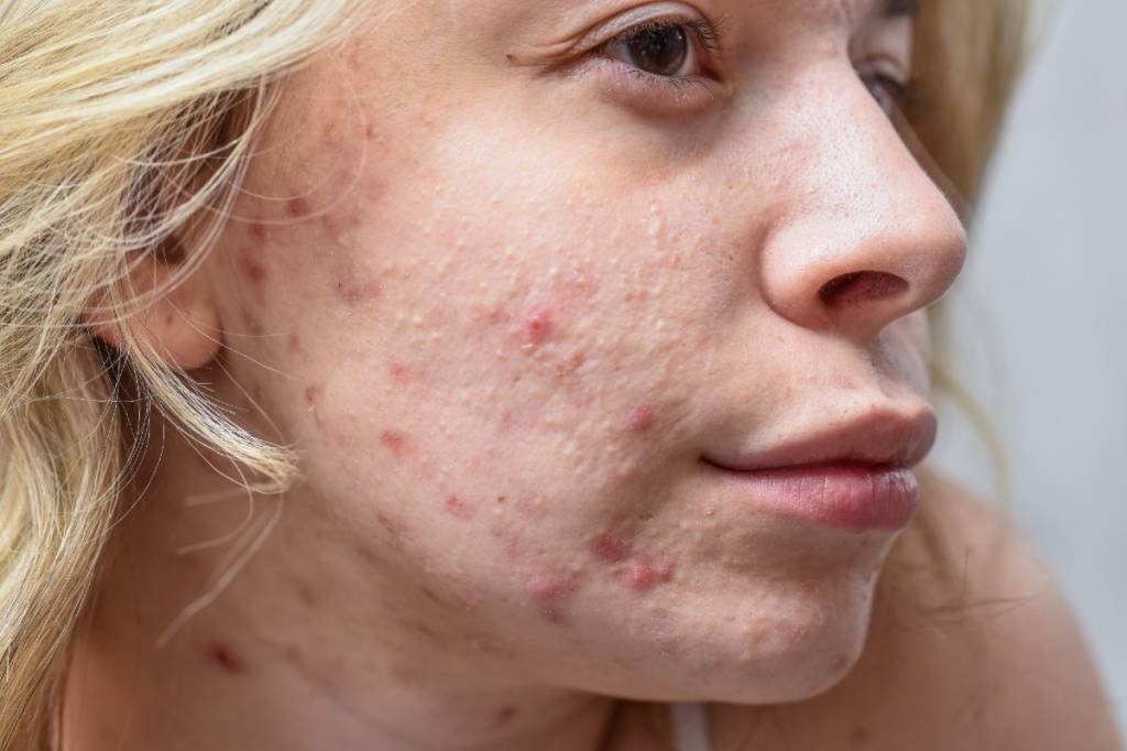 Acne: doença é tratada com ajuda de especialista em tratamentos dermatológicos (Pedrag Popovski/Getty Images)