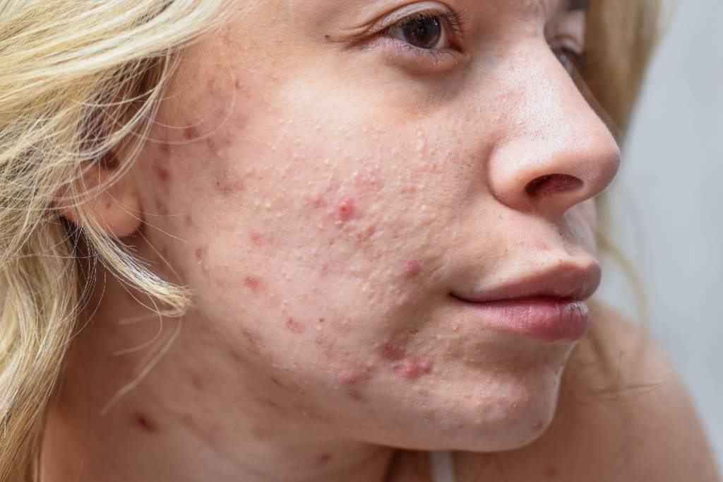 Acne: conheça os efeitos da doença em diferentes fases da vida