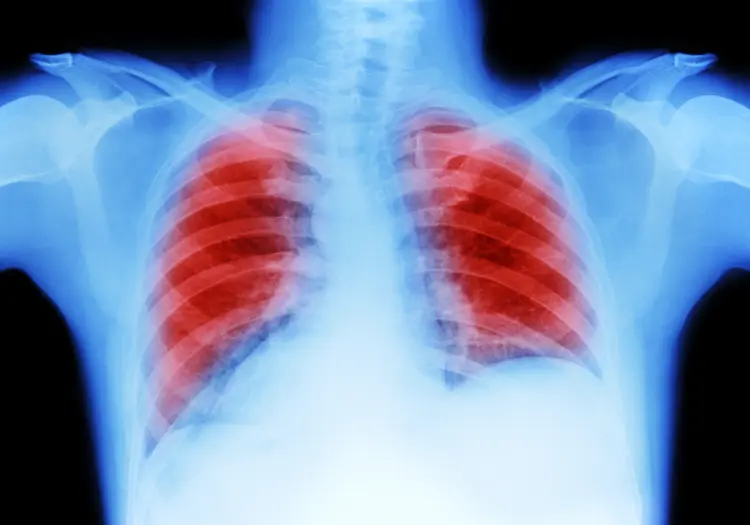 A pneumonite é a inflamação dos pulmões, dos bronquíolos e dos alvéolos pulmonares