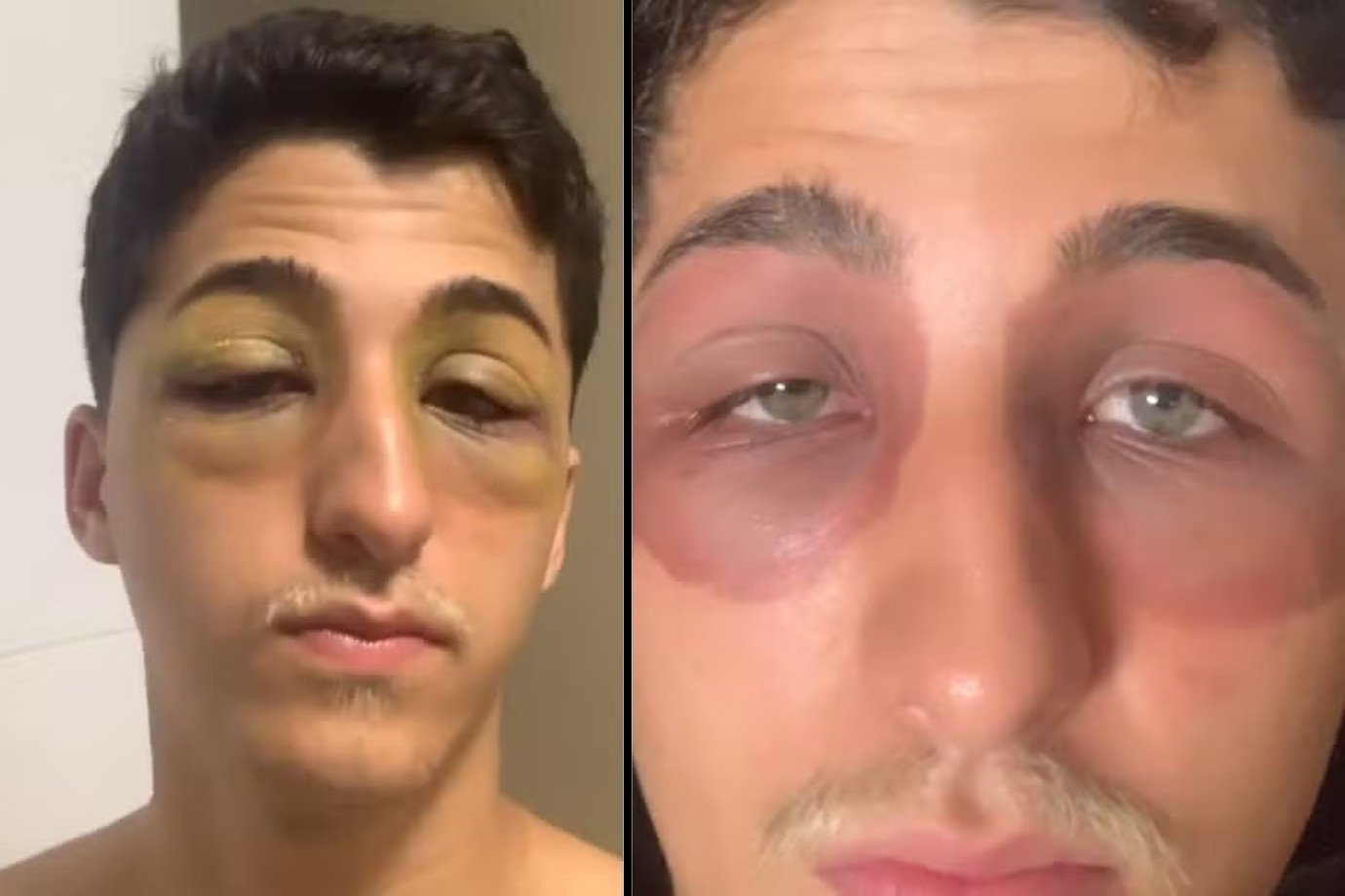 Mordida de barata? Jovem acorda com misterioso hematomas nos olhos e intriga internet; veja vídeo