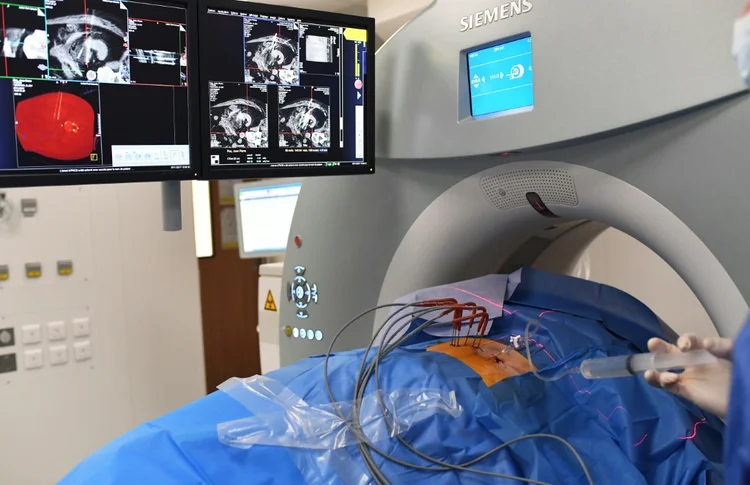 Radiologista trata um tumor maligno de um paciente com tumor renal em 7 de novembro de 2017 em Marselha, França (Julien DURY /AFP)