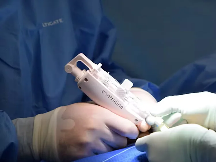 Tratamento funciona como um hidrogel injetável, administrado em uma sessão de 30 minutos (Contraline/ reprodução)