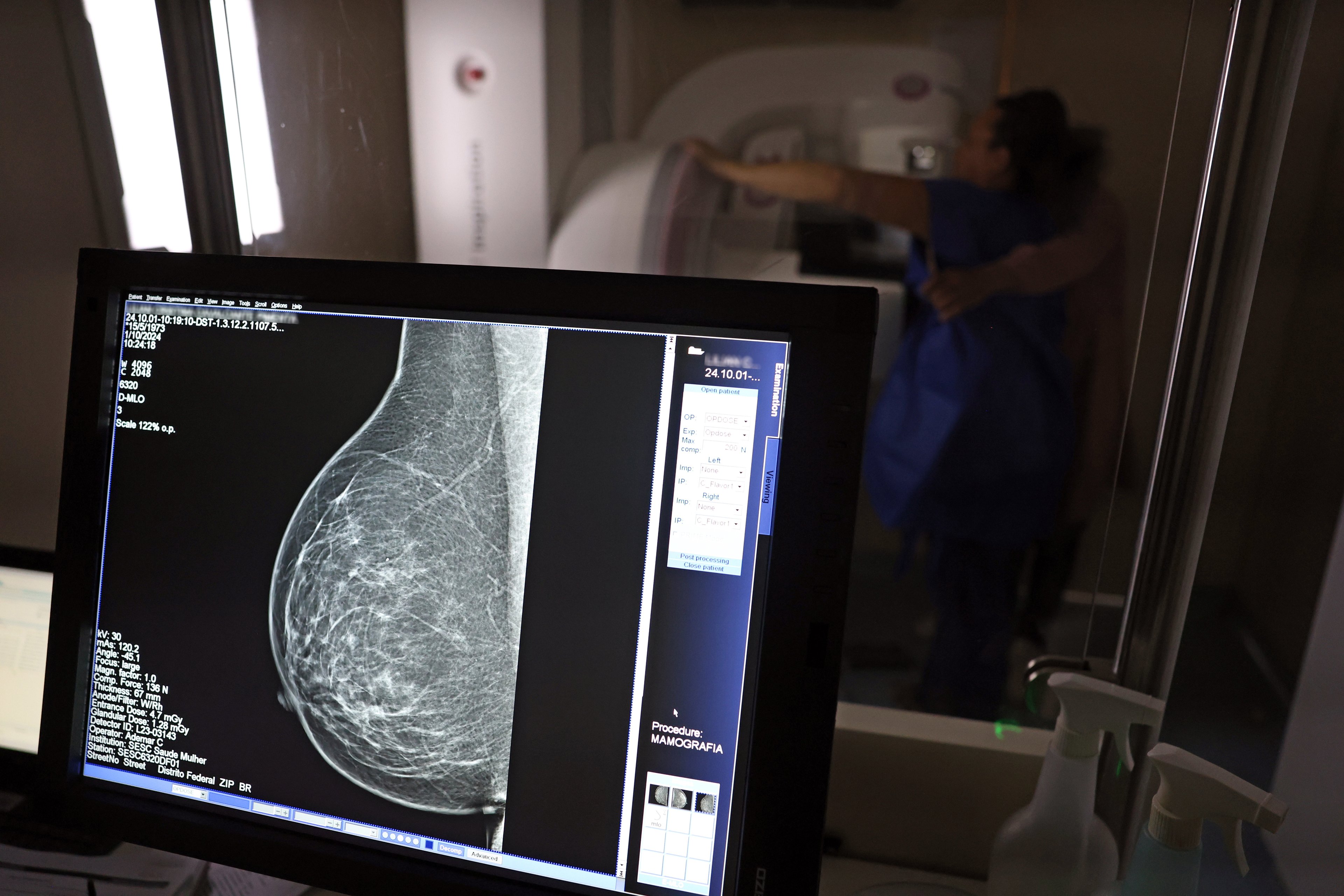 Câncer de mama: aparelho mais barato e menos invasivo para rastrear tumor é desenvolvido no Brasil