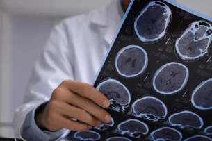 Alzheimer: estudo identifica proteína que pode antecipar diagnóstico em décadas