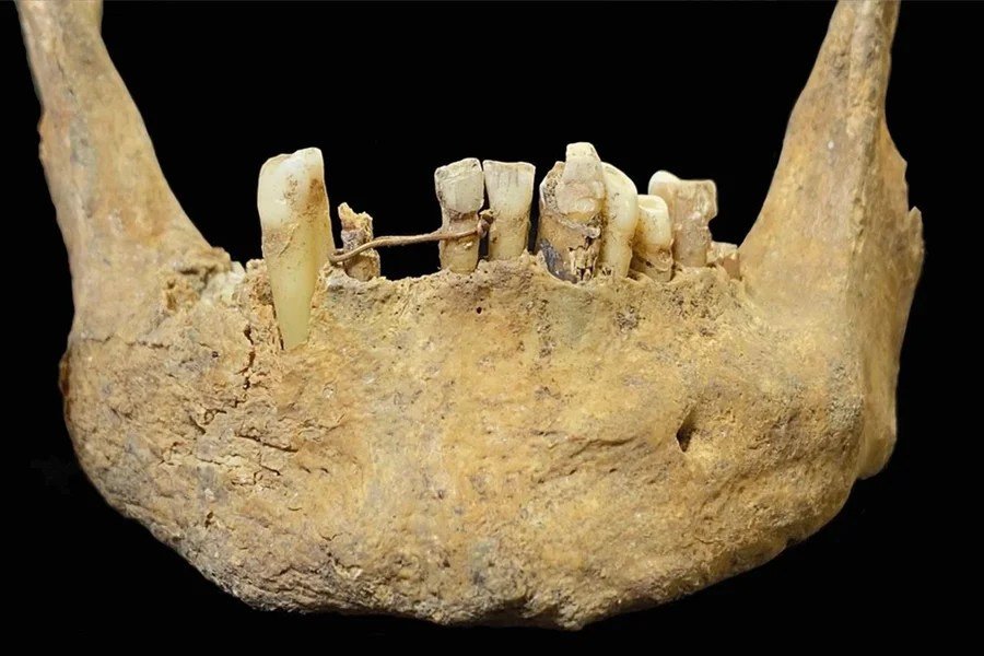 Descoberta revela 'tratamento dentário' brutal (e luxuoso) da Idade Média