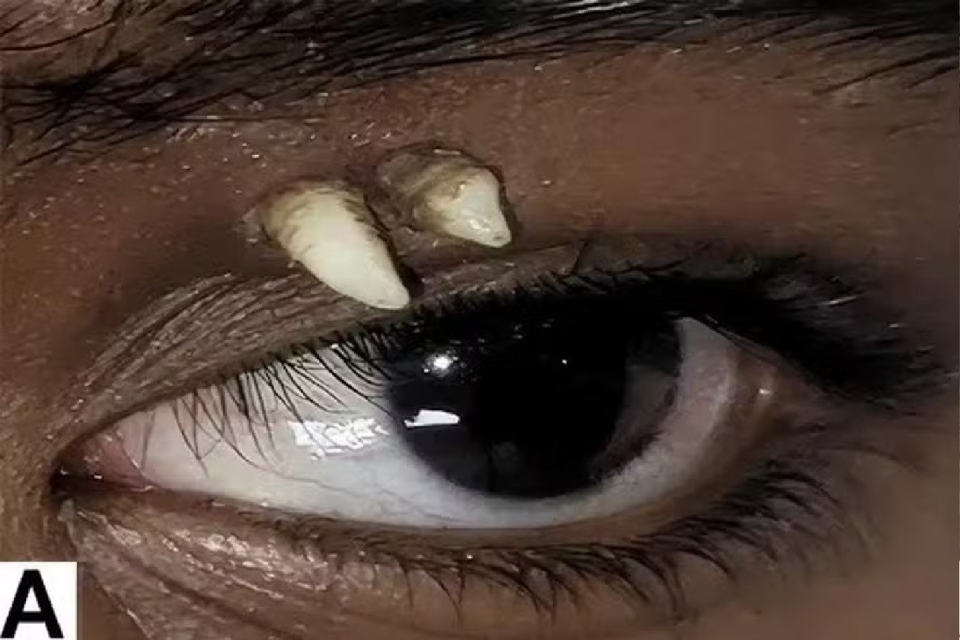 Adolescente procura médico por inchaço e descobre dentes nascendo na região do olho